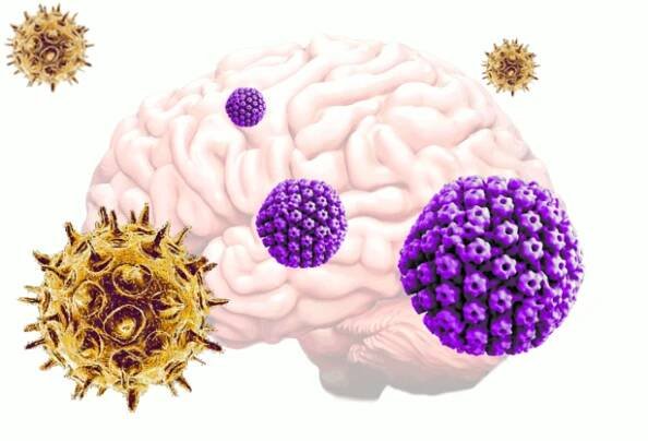 A new study speculates the chicken pox virus can reactivate a dormant herpes infection, leading to the development of Alzheimer's disease