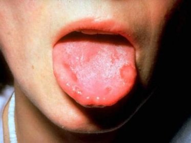 rakovina jazyka