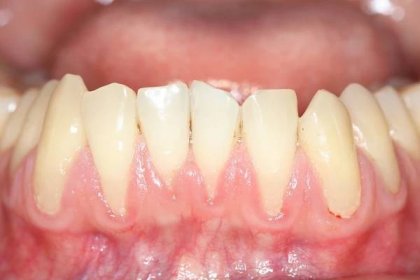 Moje zkušenost se zánětem dásní 1. Co je zánět dásní?
