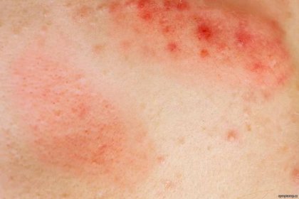 Zarudlá kůže - příznaky a léčba