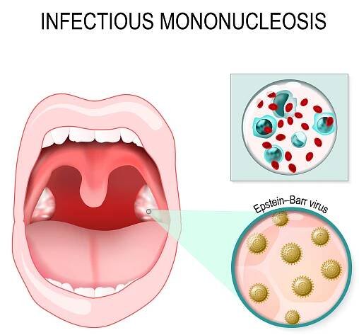 Infekční mononukleóza. vektor — Ilustrace
