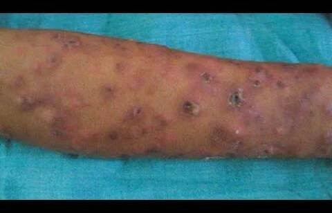 Erythema Nodosum Leprosum ENL ; Type 2 immunological reaction seen in patients with leprosy