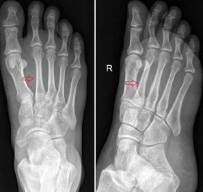 Zlomeniny päty, členkovej kosti, metatarzov a prstov nohy - Medicína a chirurgia