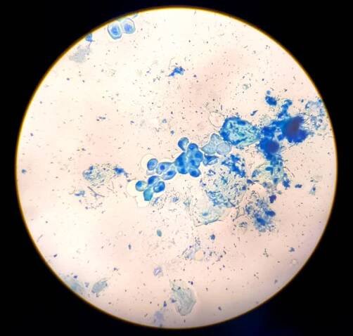 malignant cells with multiple nuclei and prominent nucleoli micrograph. - gangréna - stock snímky, obrázky a fotky