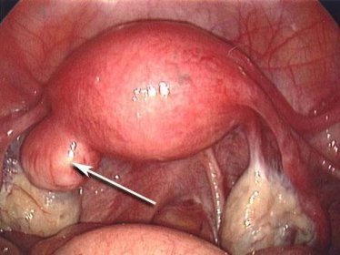 léčba polyp endometria bez operace