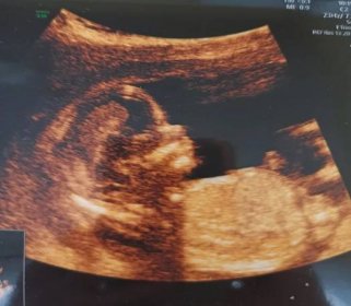 Těhotenství | Pohlaví dle fotky z ultrazvuku 13.týden těhotenství