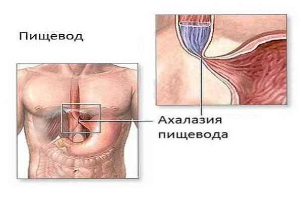 Příznaky a léčba esofagitidy, prevence a možné komplikace / Gastroenterologie | Užitečné informace a tipy na péči o sebe