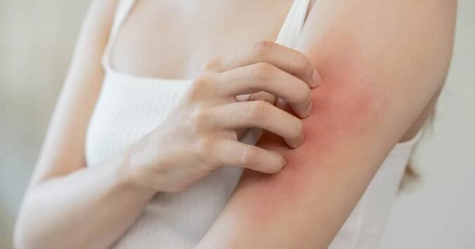 Atopická dermatitida, laicky řečeno ekzém. Novinkou je biologická léčba