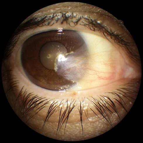 pterygium surgery - carnosidad