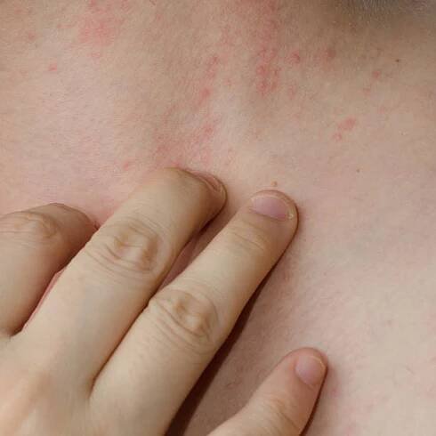 ekzém kůže na krku - kontaktní dermatitida - stock snímky, obrázky a fotky