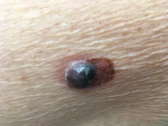 Nezhoubné a zhoubné útvary na kůži | Dermaweb