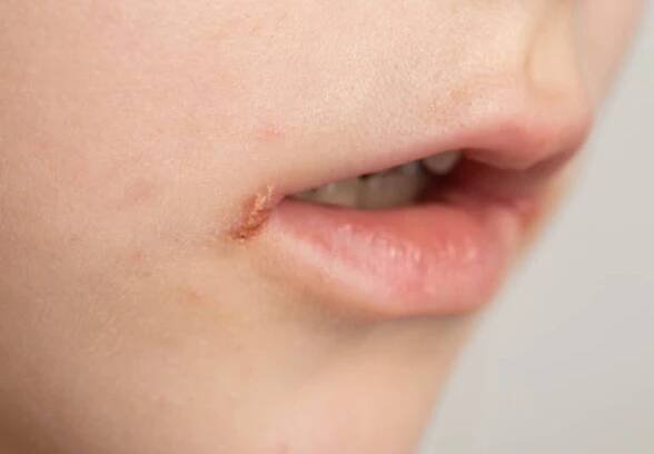 bolest a svědění v koutcích rtů dívčích úst. záchvaty na kůži, bakteriální dermatologické onemocnění. herpetická infekce, angulární cheilitida, detail, angulitida - impetigo - stock snímky, obrázky a fotky