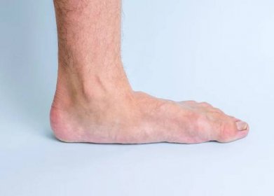 Levá noha člověka s příznaky kloubního onemocnění a ploché nohy. Nemoci nohou a kloubů. — Stock obrázek