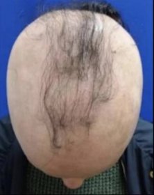 Patient with hair loss
