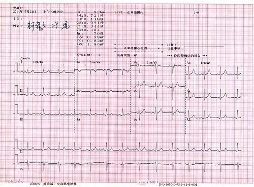 Electrocardiography - Wikipedia