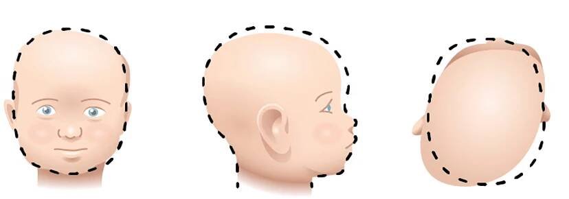 Illustrations of baby’s head shape with Plagiocephaly from 3 perspectives