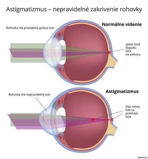 Astigmatismus - príznaky a liečba