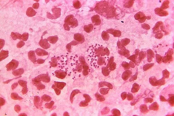 Warning issued over ‘untreatable’ gonorrhoea amid rise in cases