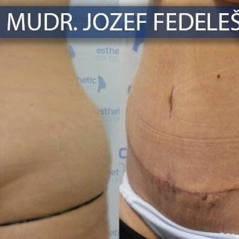 Abdominoplastika – fotky pred a po | eveclinic Bratislava