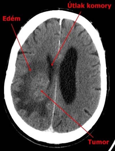 Tumor mozku - CT | Medicína, nemoci, studium na 1. LF UK