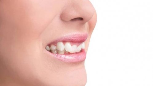Křivé zuby? Jak jim lze předcházet v dětství a jak je řešit v dospělosti