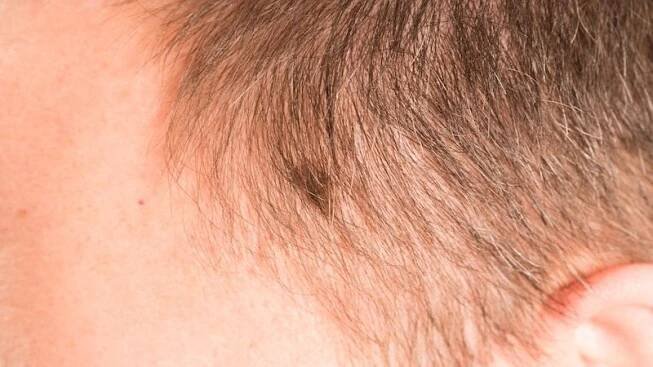 Mateřská znaménka nejsou nejčastějším místem vzniku melanomu - Novinky