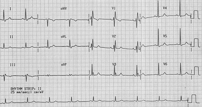 ECG complete RBBB, QRS duration, notched R wave (V1), Slurred S wave (V6) 40ms, normal R peak time