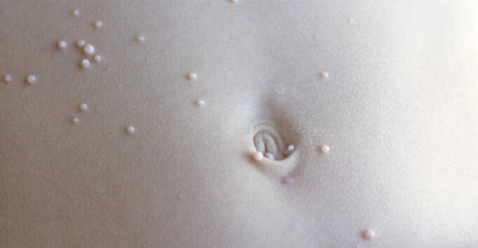 What is Molluscum Contagiosum? - Orlando FL - Dr. Jeannette Hudgens