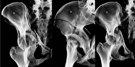 2, provedena osteosyntéza z kombinovaného přístupu ilioingvinálního a dorzálního: a, b, c úrazové snímky; d stav 6 měsíců po osteosyntéze; e, f pro bolestivost při zátěži provedeno CT vyšetření,