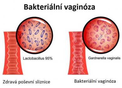 Gardnerella vaginitis je druh mikroorganismu, který způsobuje bakteriální vaginózu