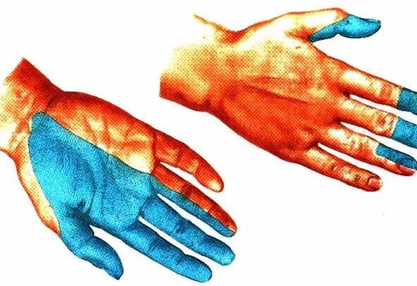 Svatební noční syndrom nebo co je neuropatie radiálního nervu / Články