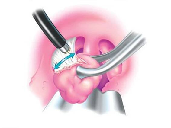 Coblation Surgeries - Aahan ENT Clinic - Dr.Ajay Doiphode