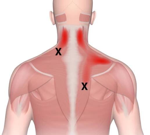 Trigger Points: Why Stretching Is Not The Answer