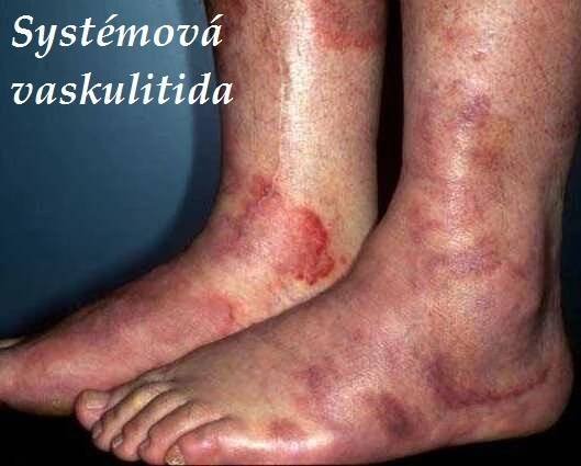 Systémová vaskulitida – příznaky, projevy, symptomy, příčina, léčba