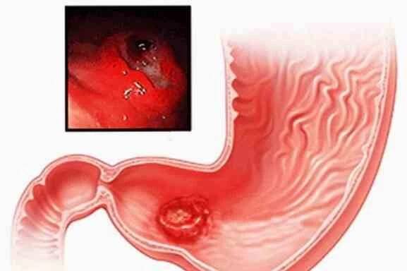 Příznaky žaludečního leiomyomu, moderní metody léčby / Gastroenterologie
