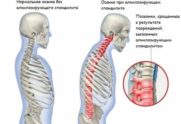 Bolest dolní části zad může být symptomem ankylozující spondylitidy. / Články