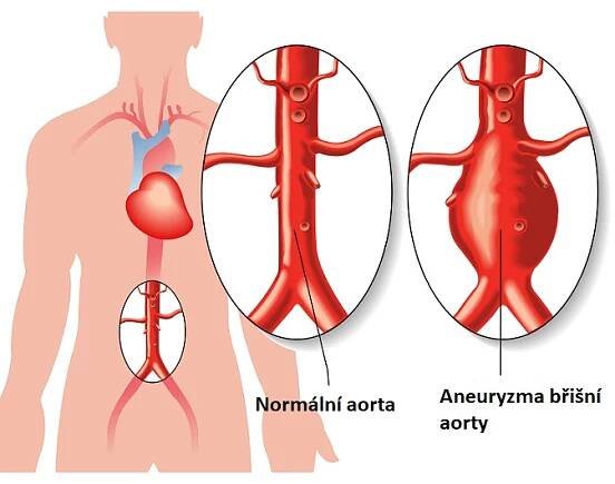 Aneuryzma břišní aorty - ilustrace