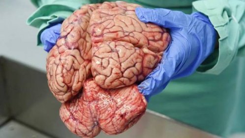 Proč nejde transplantovat mozek? Výčet důvodů je velmi zajímavý a téměř nekonečný