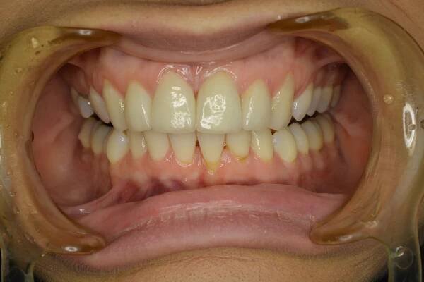 Vysoká estetika - zubné korunky E-max SMILE DENTAL IMPLANT CLINIC
