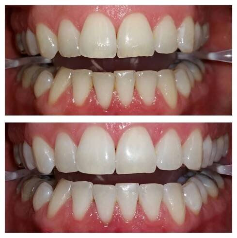 Bleaching Ergebnisse