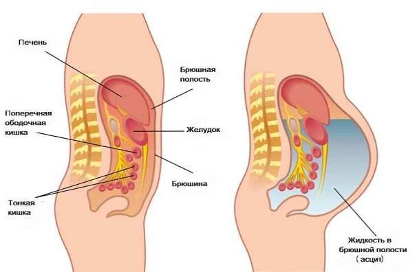 Ascites způsobuje příznaky, stadia, léčbu / Chirurgie | Užitečné informace a tipy na péči o sebe. Zdraví, výživa a další