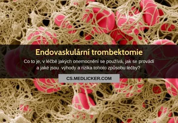 Co je endovaskulární trombektomie a jaké nemoci pomáhá léčit?