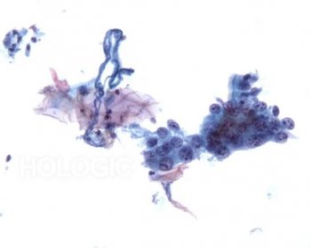 Respiratory Cytology – Large Cell – Undifferentiated Carcinoma – CytologyStuff