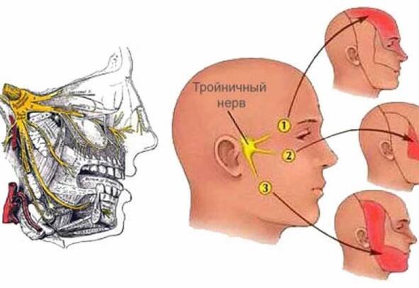 Neuralgie trigeminu - proč se vyskytuje a jak se léčit / Články