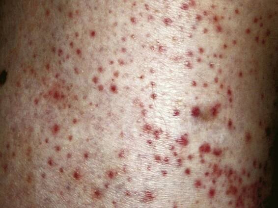 Id reaction