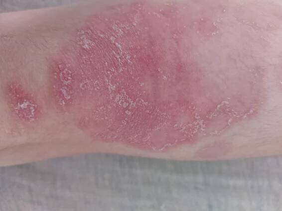 Psoriáza u 1,5 ročného dieťaťa - Modrý koník