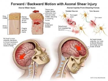 image of axonal shear injury used in a trial