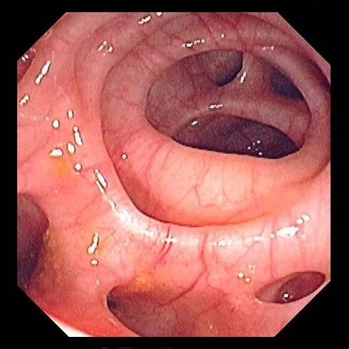 Colonic Diverticulosis - Gastrointestinal Disorders - Merck Manual Professional Edition