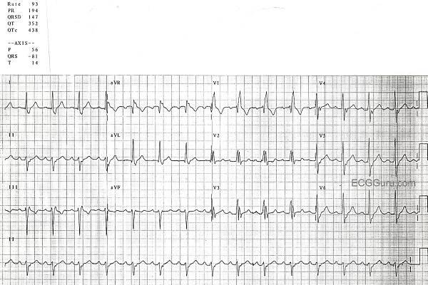 LAFB | ECG Guru - Instructor Resources