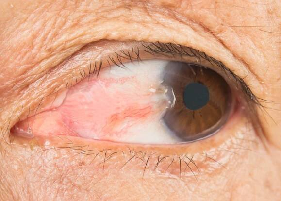 Pterygium is a raised, fleshy growth on your cornea that contains many blood vessels